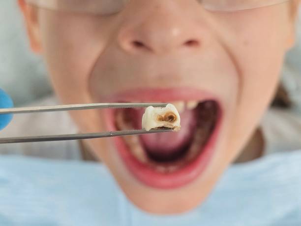 Best Emergency Wisdom Teeth Removal in Hopkinsville, KY