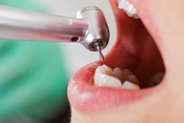 Best Emergency Broken Tooth Repair in Hopkinsville, KY